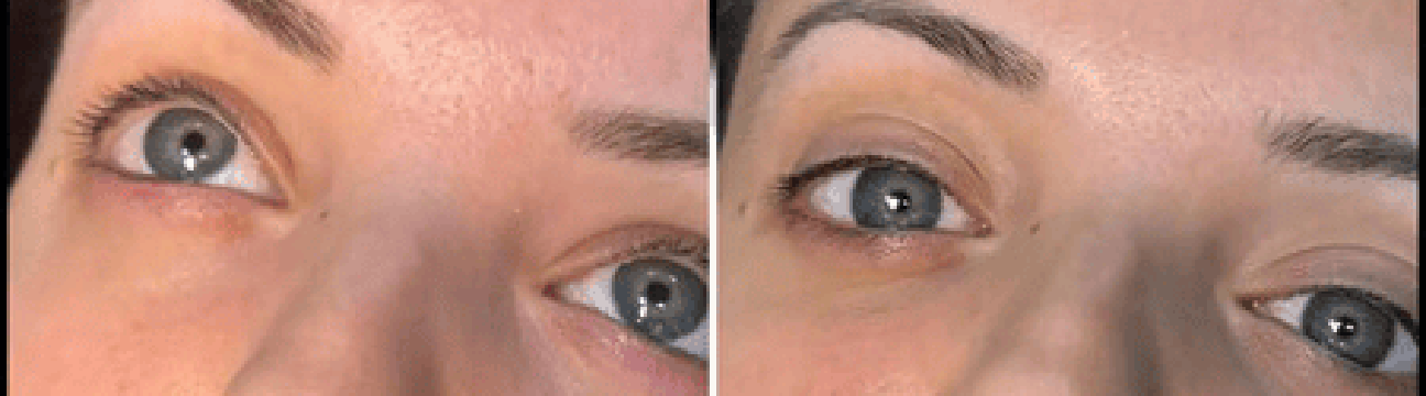 Dermal Fillers